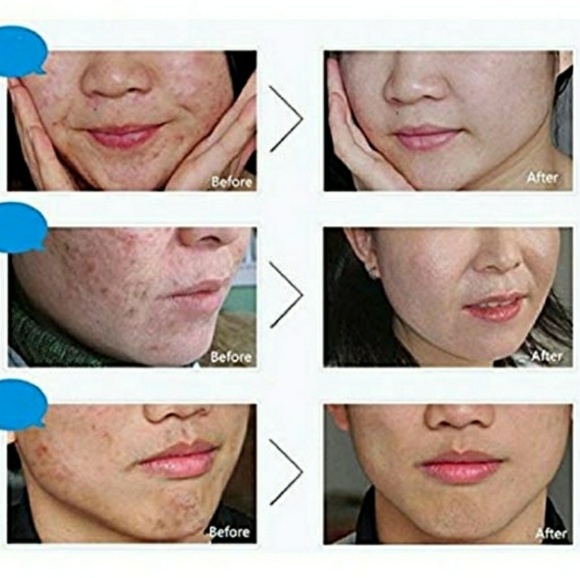 BioAqua Pure Skin Acne Removal Cream - Picture 3 of 6